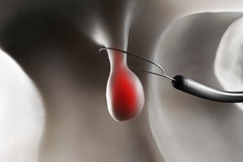 Polyp dạ dày thường là lành tính không cần phải điều trị. Tuy nhiên với những trường hợp khối u lớn và có khả năng tiến triển thành ung thư thì cần phải phẫu thuật cắt bỏ.