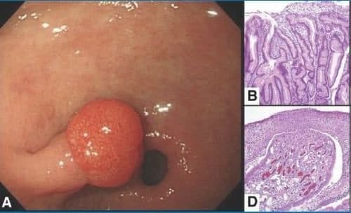 Polyp dạ dày là khối các tế bào hình thành trên lớp niêm mạc bên trong dạ dày. 