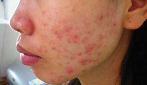 Da bị mụn mủ sưng đỏ cần được điều trị đúng cách 