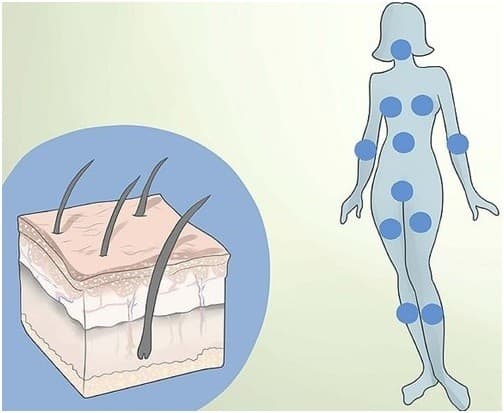 Có ria mép, da nhờn, có mụn trứng cá, tóc có gàu,… là những dấu hiệu của bệnh đa nang buồng trứngCó ria mép, da nhờn, có mụn trứng cá, tóc có gàu,… là những dấu hiệu của bệnh đa nang buồng trứng.