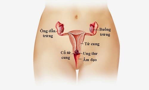 Đi khám ung thư cổ tử cung ở đâu