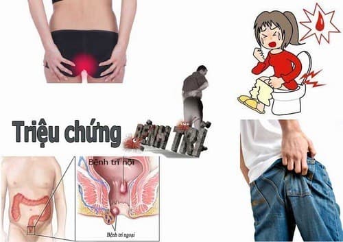 Đi ngoài ra máu có thể là dấu hiệu bệnh trĩ
