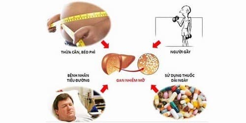 Điều trị gan nhiễm mỡ cần chẩn đoán đúng nguyên nhân gây bệnh