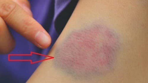 Giảm tiểu cầu gây hiện tượng xuất huyết dưới da