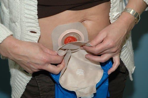 Hậu môn nhân tạo