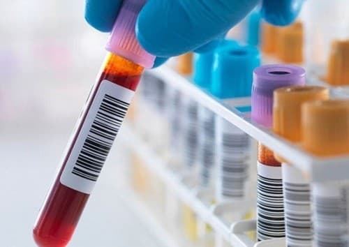 Xét nghiệm kiểm tra chức năng gan cần thiết trong chẩn đoán và theo dõi tình hình sức khỏe