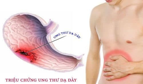 Người bệnh ung thư dạ dày sẽ có triệu chứng đau bụng, ợ chua, khó tiêu... ảnh hưởng tới sức khỏe