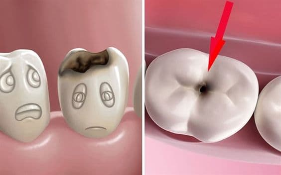 Nguyên nhân sâu răng là do vi khuẩn gây sâu răng có sẵn trong miệng, chủ yếu là vi khuẩn Streptococcus Mutans