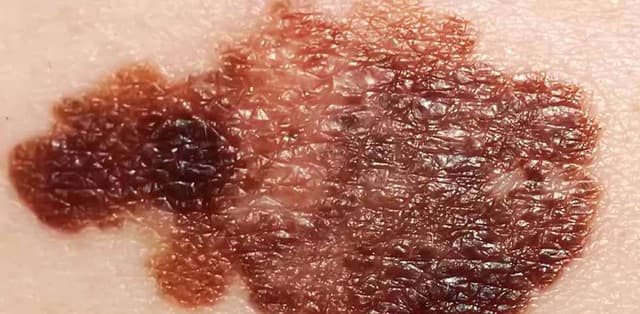 Điều trị u hắc tố ác tính như thế nào?