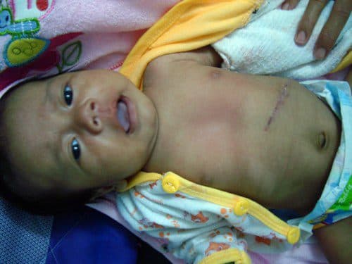 Phẫu thuật là phương pháp chính được áp dụng để cải thiện tình trạng bệnh cho trẻ