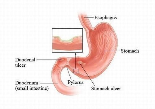 Thủng dạ dày tá tràng do viêm loét niêm mạc nặng hoặc do những sẹo non, sẹo già trên thành ruột. 