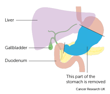 Phẫu thuật ung thư dạ dày