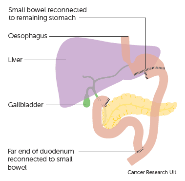 Phẫu thuật ung thư dạ dày