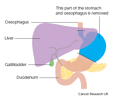 Phau thuat ung thu da day