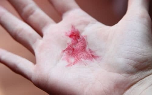 Nôn ra máu là dấu hiệu dễ nhận biết khi bị xuất huyết dạ dày