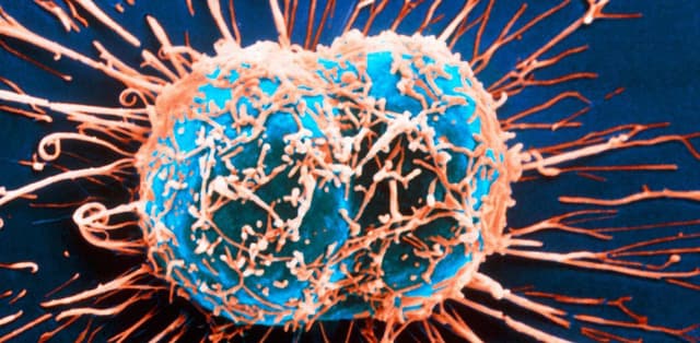 Ung thư di căn là gì? Ung thư có thể di căn đến vị trí nào