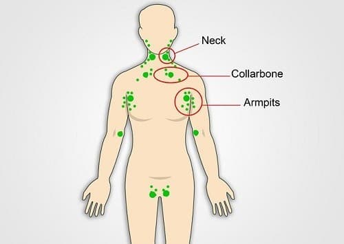 Ung thư hạch bạch huyết 