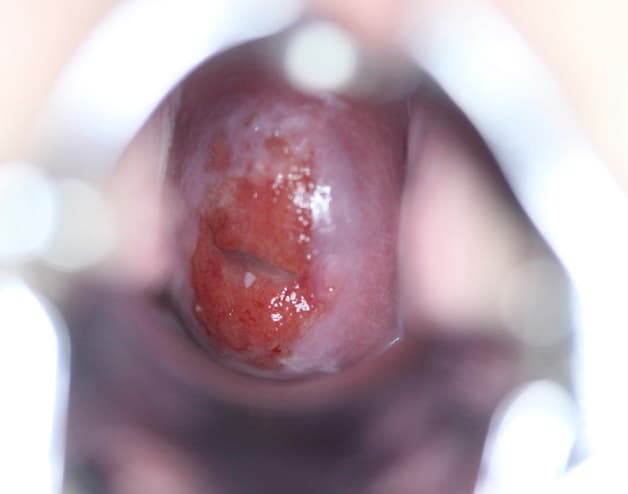 Nguyên nhân gây viêm lộ tuyến cổ tử cung