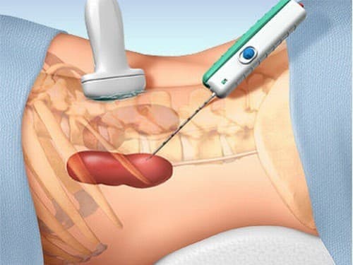 Sinh thiết thận là chỉ định cần thiết để xét nghiệm chức năng thận, địa chỉ nào uy tín