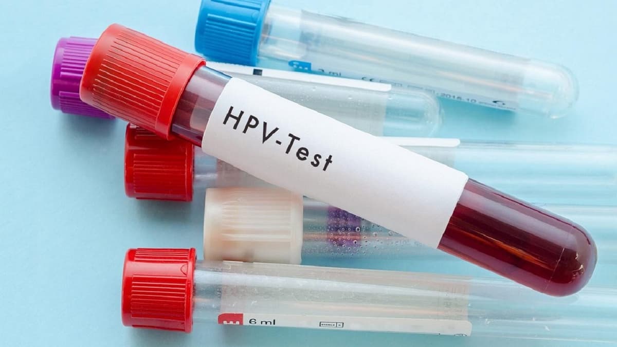 Xét nghiệm HPV là gì? Xét nghiệm HPV giá bao nhiêu?