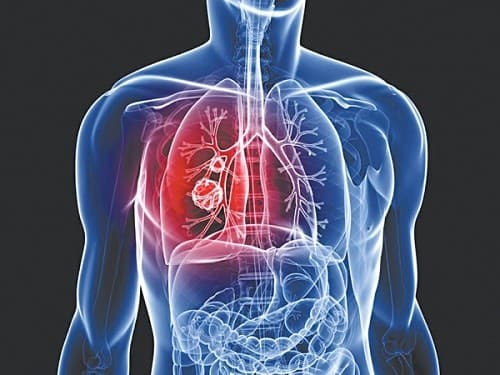 Xét nghiệm ung thư phổi ở đâu tốt