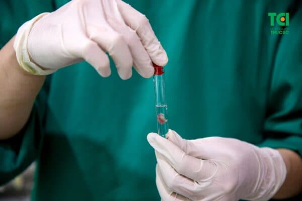 Hình ảnh polyp sau khi cắt