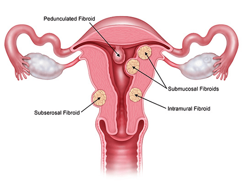 Bệnh nhân xơ tử cung là gì? Cách nhận biết và xử trí kịp thời