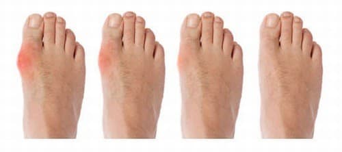 Biểu hiện của bệnh gút? điều trị bệnh gút hiệu quả