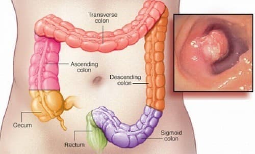 Polyp hậu môn cần được phát hiện sớm và điều trị hiệu quả