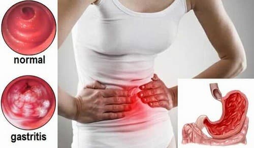 Chảy máu dạ dày cần được phát hiện sớm và điều trị kịp thời