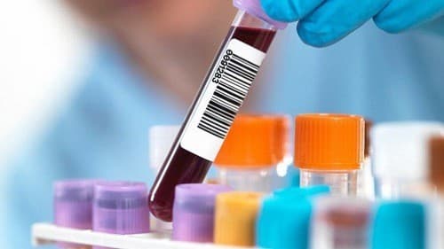 Chỉ số ggt chẩn đoán tình trạng sức khỏe. Vậy chỉ số ggt bao nhiêu là cao?