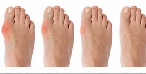 Dấu hiệu sưng viêm khớp cảnh báo bệnh gút cần được phát hiện sớm và điều trị kịp thời hiệu quả