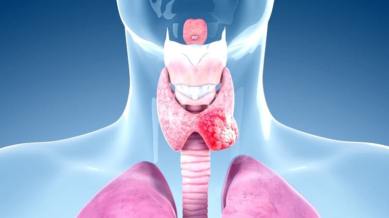 Ung thư tuyến giáp giai đoạn cuối có thể di căn đến xương, phổi…