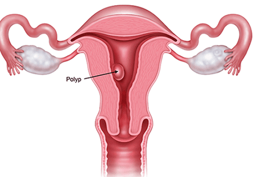 Điều trị polyp cổ tử cung thế nào?
