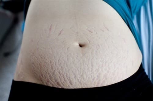 Rạn da khi mang thai ảnh hưởng đến cả sau sinh.