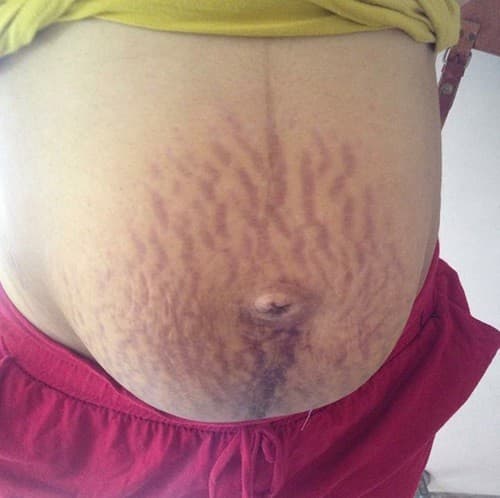 Trên thực tế, không ít bà bầu đối mặt với chứng rạn da tím mất thẩm mỹ. 