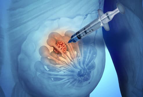 hình ảnh ung thư vú