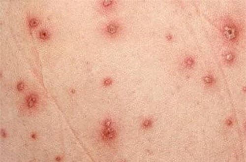 HPV xâm nhập vào cơ thể gây nên nhiều bệnh lý truyền nhiễm nguy hiểm