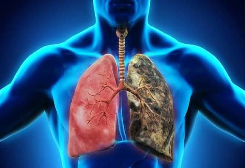 Ung thư phổi giai đoạn cuối di căn rộng đến gan, xương, thận,,,