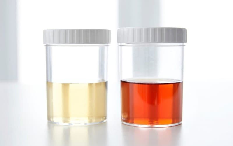 Triệu chứng tiểu ra máu biểu hiện cụ thể như thế nào?