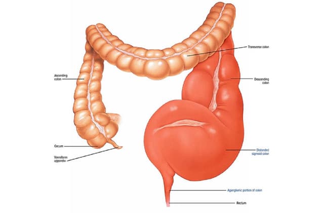 Tìm hiểu về bệnh phình đại tràng