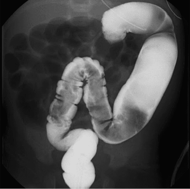 chẩn đoán phình đại tràng