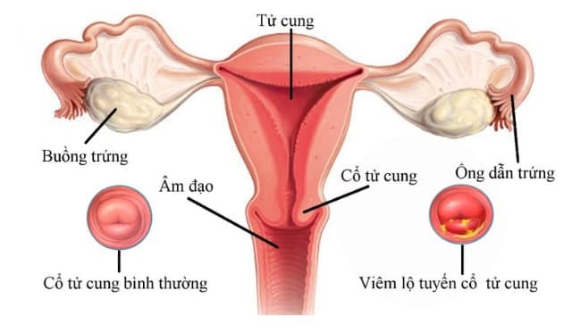 Viêm lộ tuyến cổ tử cung là một trong những căn bệnh phụ khoa phổ biến mà rất nhiều chị em gặp phải, nhất là những chị em trong độ tuổi sinh sản, từng nạo phá thai nhiều lần.