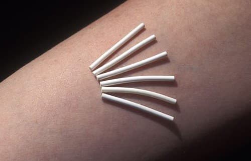 Sau sinh bao lâu thì cấy que tránh thai là điều rất nhiều chị em thắc mắc