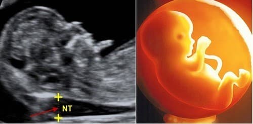 Siêu âm thai ở độ tuổi thai này, bác sĩ sẽ khảo sát những dấu hiệu bất thường của nhiễm sắc thể