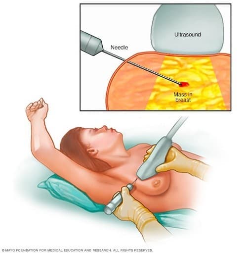 siêu âm tuyến vú