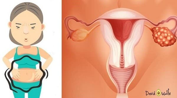 Trắc nghiệm nhanh về ung thư buồng trứng