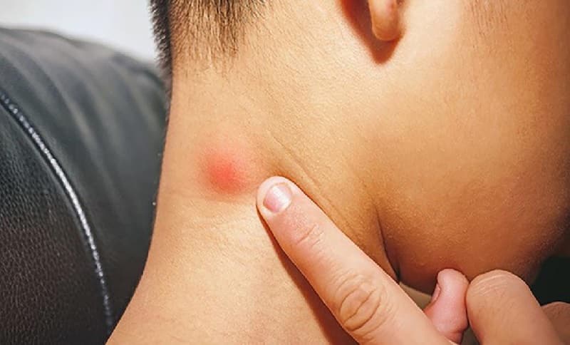 Khối u hạch nổi ở cổ có thể lành tính nhưng cũng có thể là dấu hiệu cảnh báo ung thư tuyến giáp