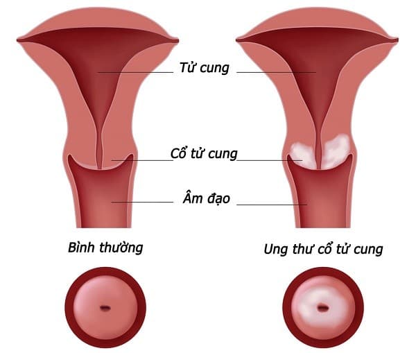 Ung thư cổ tử cung có di truyền không?