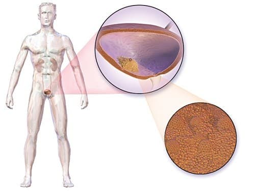 ung thư dương vật